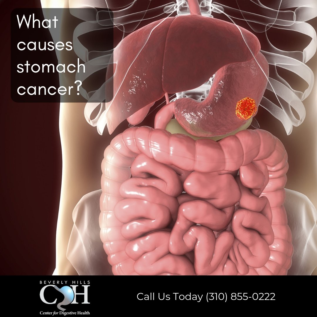 GastroDoctorLA's tweet photo. Scientists aren't sure what makes cancer cells start growing in the stomach. 

A few things can raise your risks: 
H pylori 
smoking 
obesity 
a diet high in smoked, pickled, or salty foods.

#beverlyhillscenterfordigestivehealth #stomachcancer #hpylori https://t.co/XYASN3l9cD
