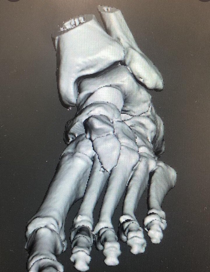 3d_maranon's tweet photo. This case corresponds to a fracture-dislocation of the midfoot. It will help understanding the injury and plan the surgery accordingly. FabLab team: @rupermac @calvoharo_ja @diegotrap  @AbyAmselem https://t.co/E3QeKeUAGr