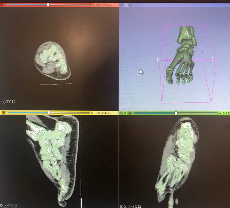 3d_maranon's tweet photo. This case corresponds to a fracture-dislocation of the midfoot. It will help understanding the injury and plan the surgery accordingly. FabLab team: @rupermac @calvoharo_ja @diegotrap  @AbyAmselem https://t.co/E3QeKeUAGr