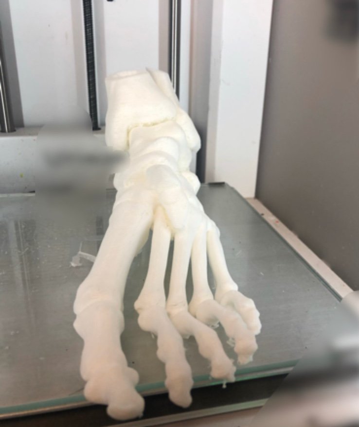 3d_maranon's tweet photo. This case corresponds to a fracture-dislocation of the midfoot. It will help understanding the injury and plan the surgery accordingly. FabLab team: @rupermac @calvoharo_ja @diegotrap  @AbyAmselem https://t.co/E3QeKeUAGr