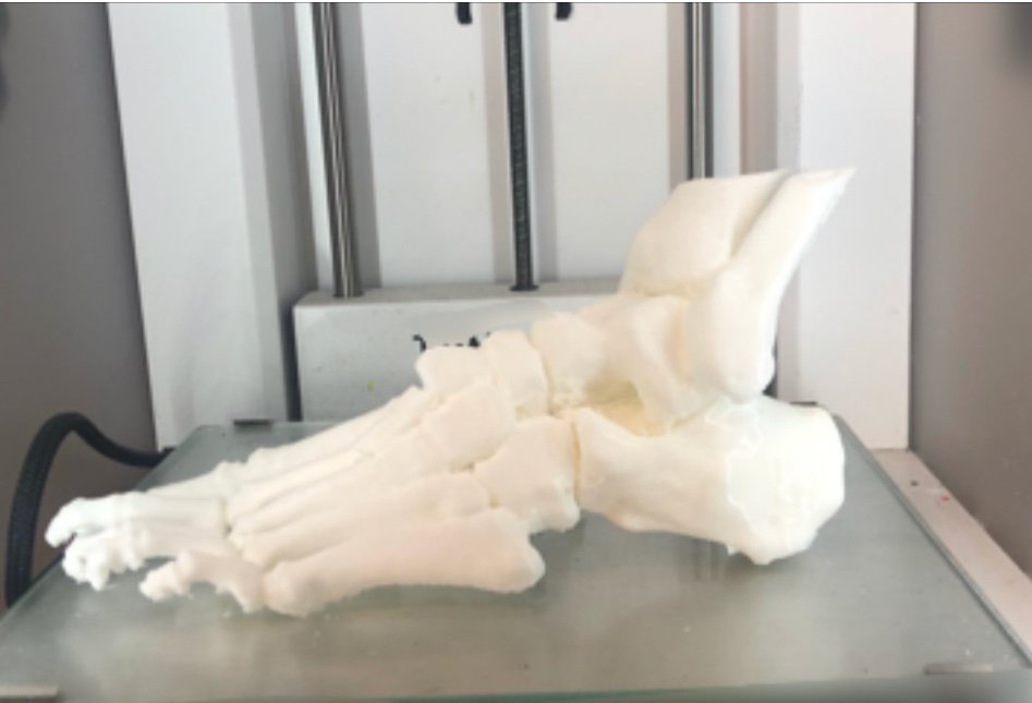 3d_maranon's tweet photo. This case corresponds to a fracture-dislocation of the midfoot. It will help understanding the injury and plan the surgery accordingly. FabLab team: @rupermac @calvoharo_ja @diegotrap  @AbyAmselem https://t.co/E3QeKeUAGr