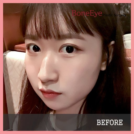 BoneeyePlastic's tweet photo. ๐ Look how beautiful her nose is!!!
๐ Very slim and smooth!! WoW
โ๏ธ rhynoplasty - humpectomy
#boneeye #koreanclinic #koreansurgeon #rhynoplasty #humpectomy #nosesurgery #beautifulnose #wannabe #belike #beautifulgirl #prettygirl #gangnamsquare https://t.co/32oxsEXa0I