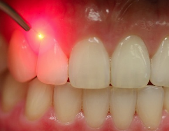 Lower Manhattan Pediatric Dentist, Dr. Jacqueline Dikansky, explains dental lasers on her July blog here: ismilekids.com/blog/what-are-…

#NYCPediatricdentist #LowerManhattanPediatricDentist #DentalLasers