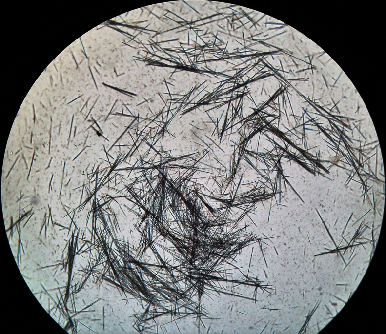 JoseTesser's tweet photo. Amoxicillin crystalluria. Bright field (left) and phase contrast (right). Under polarized light they are strongly polychromatic birefringent (no image obtained unfortunatelly). #urinalysis #urinesediment https://t.co/GCVBF2Ys1h