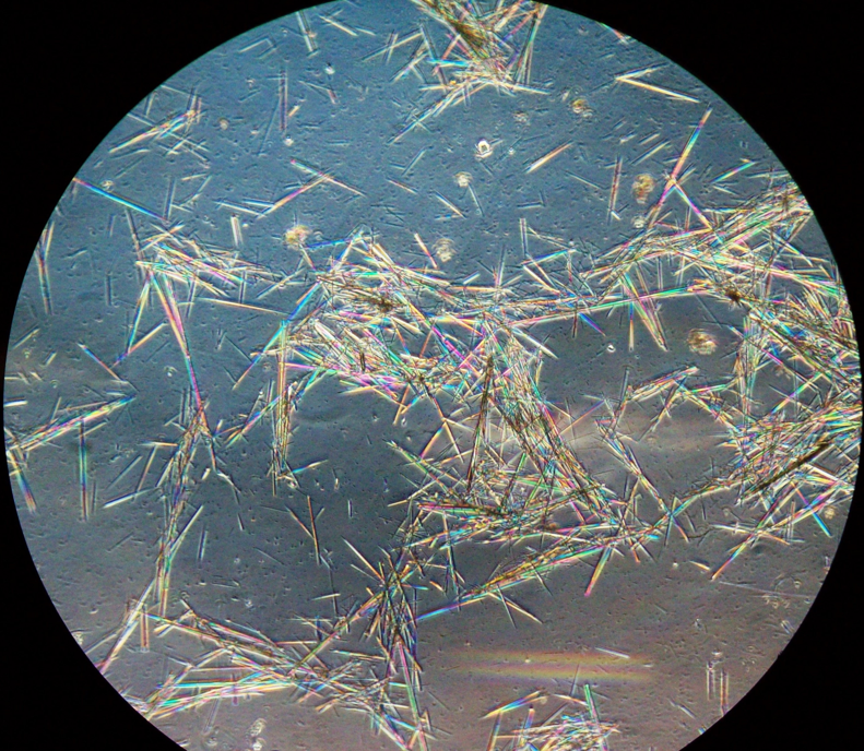 JoseTesser's tweet photo. Amoxicillin crystalluria. Bright field (left) and phase contrast (right). Under polarized light they are strongly polychromatic birefringent (no image obtained unfortunatelly). #urinalysis #urinesediment https://t.co/GCVBF2Ys1h