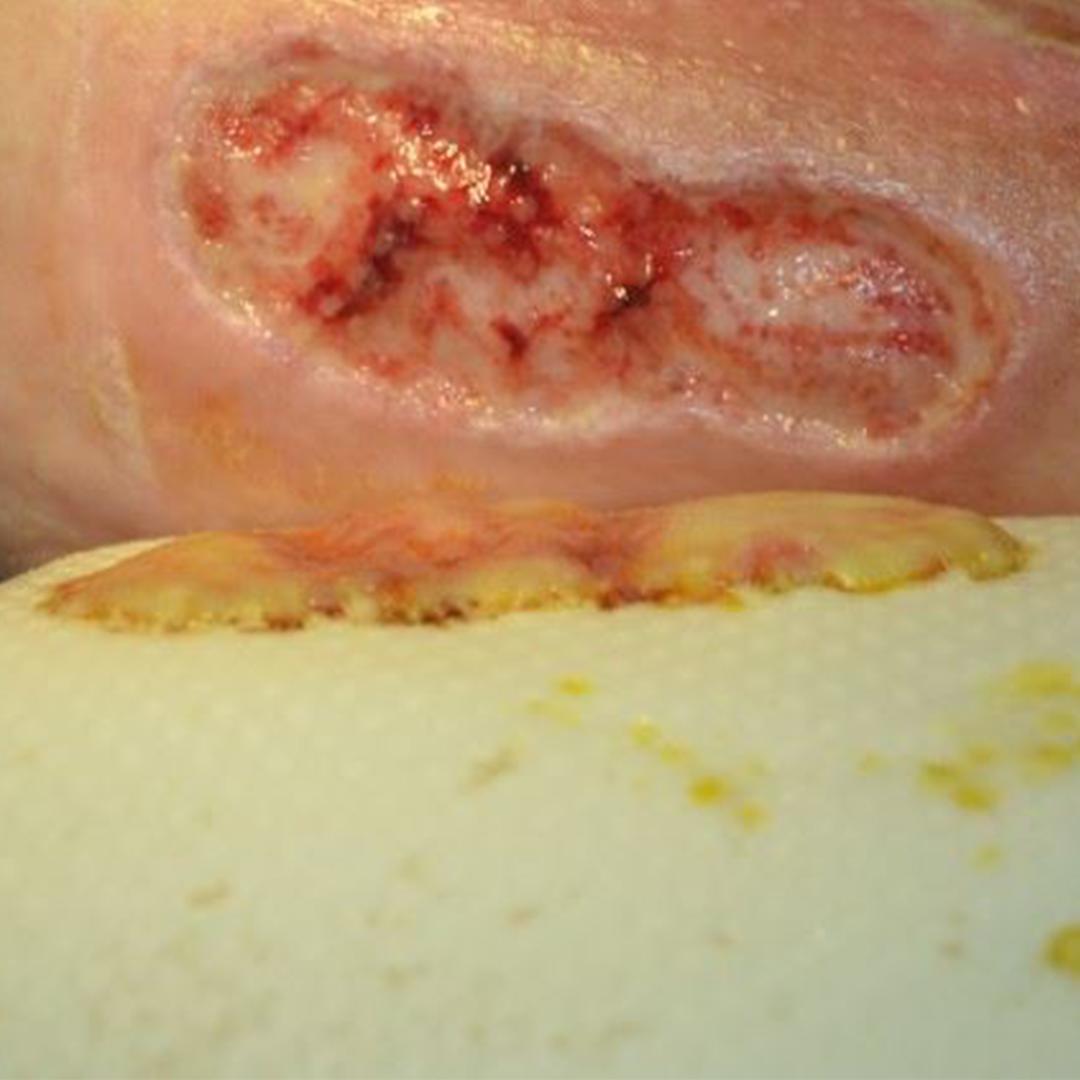 Coloplast_WCare's tweet photo. It's another #WoundWednesday from Coloplast. See if you can answer this one.

True or False...

A moist wound healing environment increases the risk of infection.

Comment True or False below. Tomorrow we will reveal the answer. https://t.co/ReEXlbOtFS