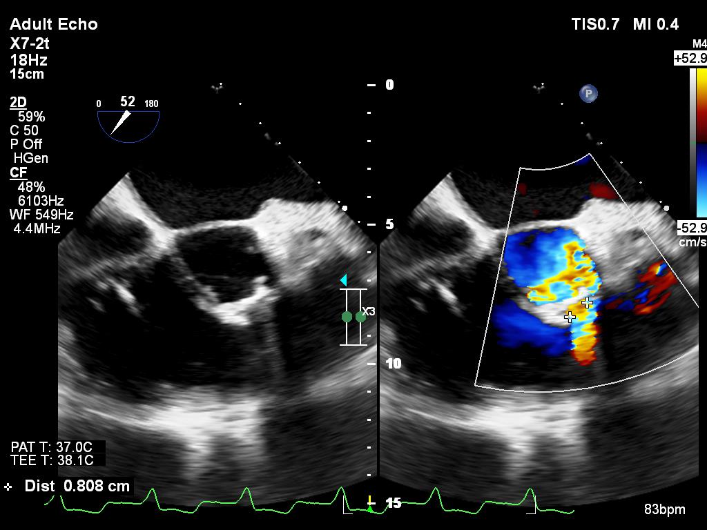 CardiacClinicTO's tweet photo. Sinus of Valsalva aneurysm rupture late post-mAVR: M late 50’s, history of mAVRx2 and Konno. Symptomatic w significant right heart failure &amp; n LV, mod PAH 51,  Aorta to RV fistula. Qp:Qs 1.5:1 How would you proceed? #cardiotwitter (1/4) https://t.co/WA4Dg6v8EH