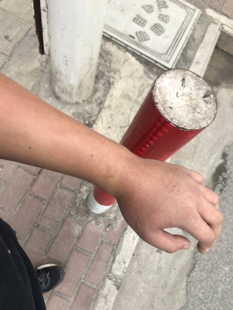 wineofowl's tweet photo. Boiga bites.
Species: Boiga cynodon. bit while feeding, and held for a few minutes 
treatment：none
symptom：entire forearm swelling, moderate pain and axillary adenopathy, almost recovered after 3 days. https://t.co/vg8py3U5mS