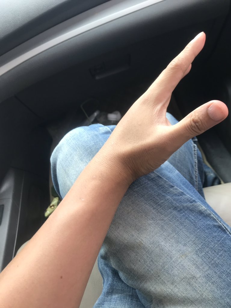 wineofowl's tweet photo. Boiga bites.
Species: Boiga cynodon. bit while feeding, and held for a few minutes 
treatment：none
symptom：entire forearm swelling, moderate pain and axillary adenopathy, almost recovered after 3 days. https://t.co/vg8py3U5mS