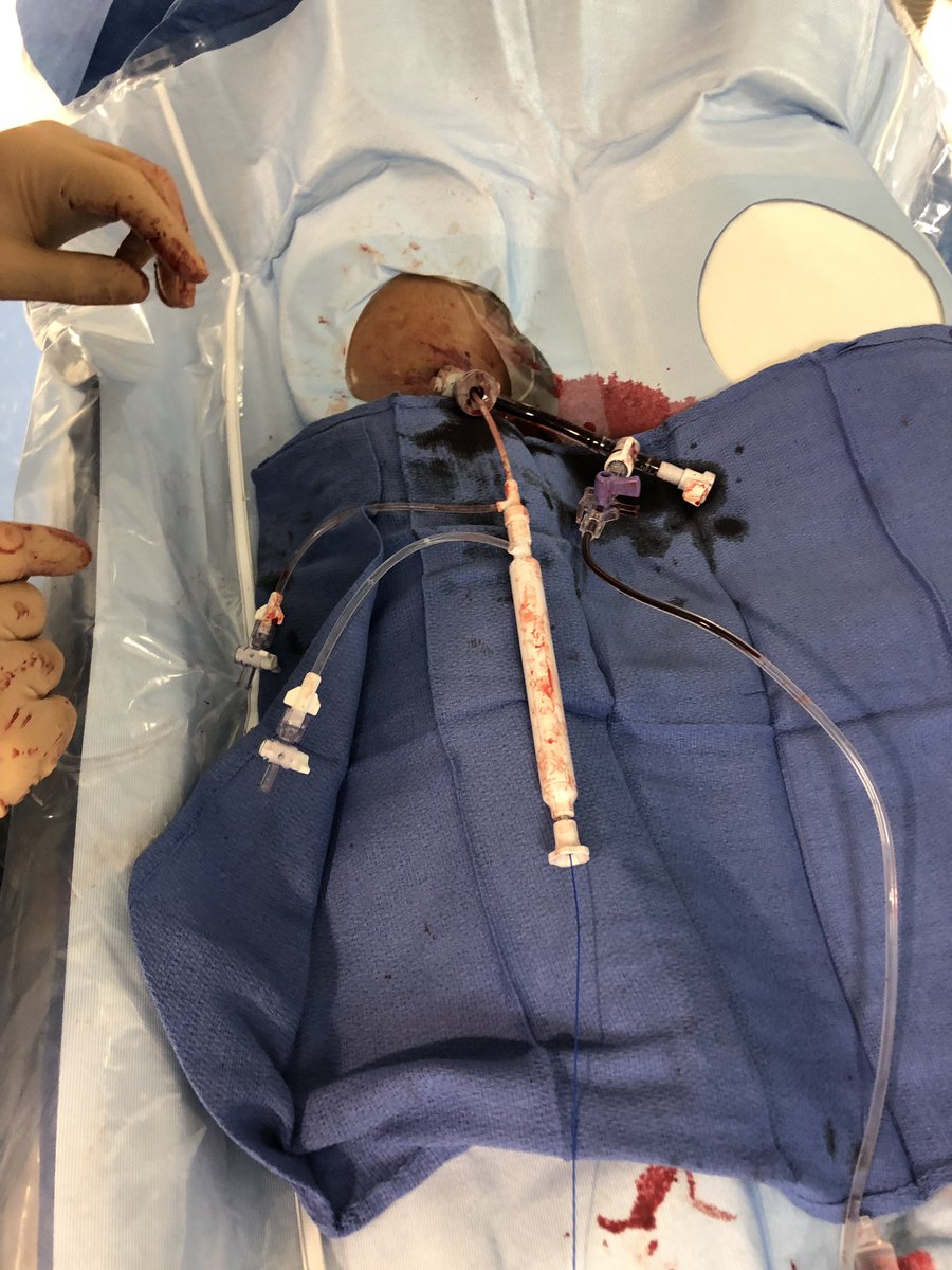 heartdoc45's tweet image. #cathlabhack for ClotTriever cases: use the flush port as a marker and rotate 90 degrees with each pass to change the orientation of the device. Seems to allow for more thorough clot removal.