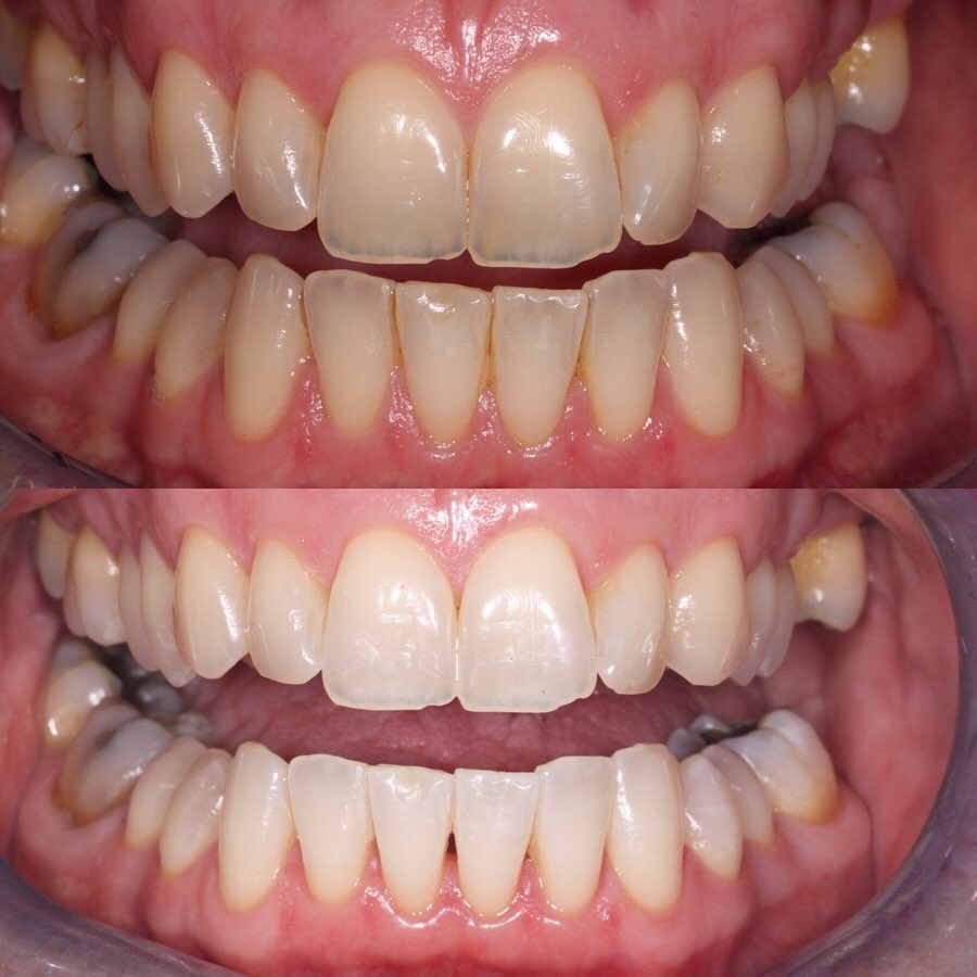 CastleCourtDent's tweet photo. Wow, what a transformation🤩!!! We are all delighted with the results from at home tooth whitening with @boutiquewhitening_ 
This simple treatment has made a huge difference to this patient’s smile and cost only £195!! https://t.co/6I2Mzdb6zx