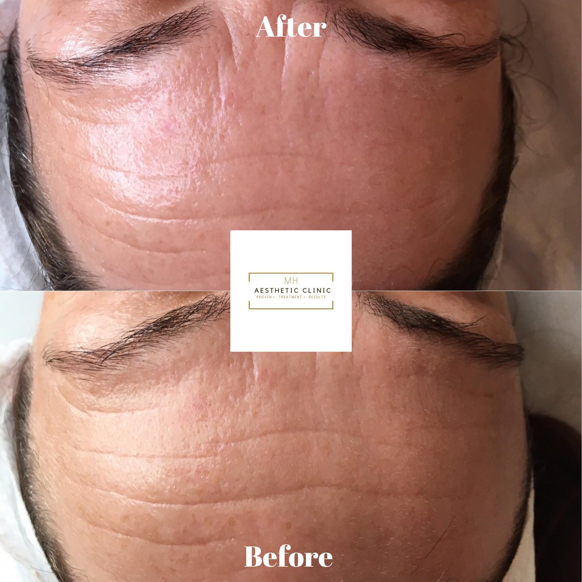 MH Aesthetic & Beauty Clinic (@clinicmh) on Twitter photo We offer the anti-ageing Hydrafacial treatment here at <a href="/ClinicMh/">MH Aesthetic & Beauty Clinic</a> and as you can see the results give plumper, smoother less visible lines and wrinkles. #wrinkles #AntiAging #hydrafacial #over40 We offer the anti-ageing Hydrafacial treatment here at <a href="/ClinicMh/">MH Aesthetic & Beauty Clinic</a> and as you can see the results give plumper, smoother less visible lines and wrinkles. #wrinkles #AntiAging #hydrafacial #over40