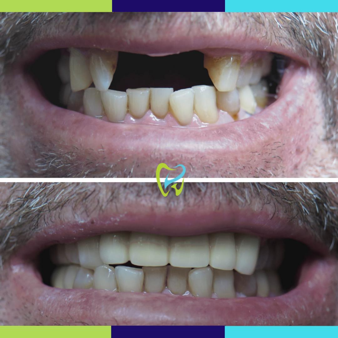 ESMDentistry's tweet photo. Missing teeth? No problem! Our dental implants can help complete your smile. Contact us today to learn more! https://t.co/7ogeMD1l2Y  

(424) 277-2671
https://t.co/oPJmYJuBWq https://t.co/bkTVYcNl5O