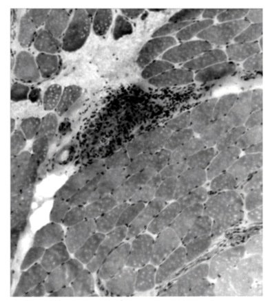 KragstrupTW's tweet photo. Muscle involvement in #sarcoidosis often without elevated muscle enzymes.
Muscle weakness.
EMG myopathic changes.
Muscle biopsy with granuloma.
https://t.co/a7RkNohUNq
@EMEUNET, #EMEUNETonCourse, @eular_org, #module10, promoting knowledge-sharing in rheumatology. https://t.co/45v77yluxC