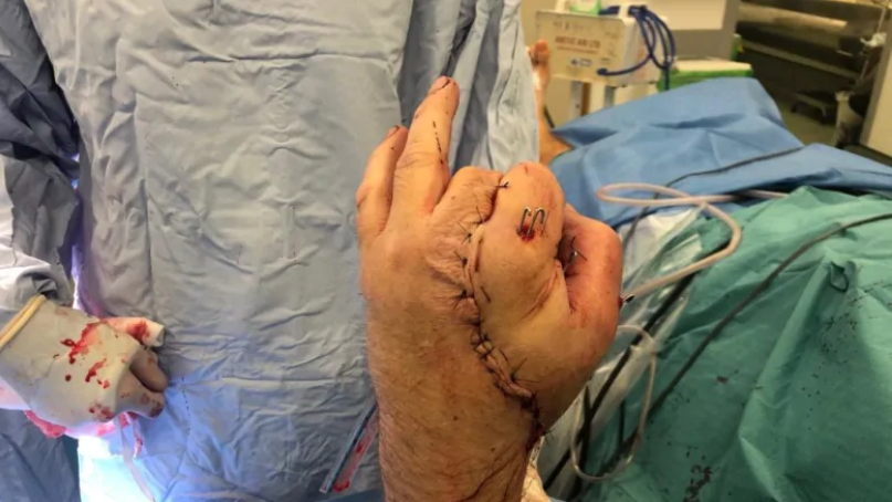 cbcasithappens's tweet photo. Doctors at @StGeorgesTrust saved a carpenter's severed hand by sewing it to his groin for two weeks https://t.co/PMDVhfjKlT https://t.co/a4GSTWBNs9