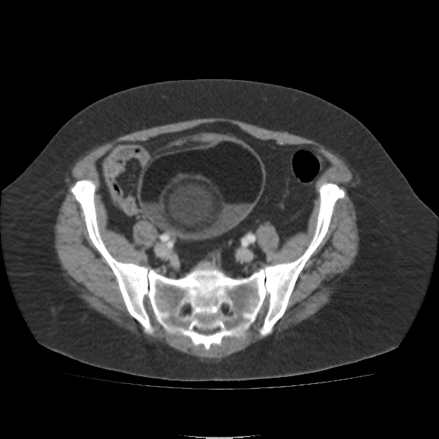 SGaibrie's tweet photo. Today I learned that the "pokeball sign" is a real radiology finding and its seen in ovarian teratoma... That is all for today folks @jonesmcella https://t.co/f8TSTNPvC6