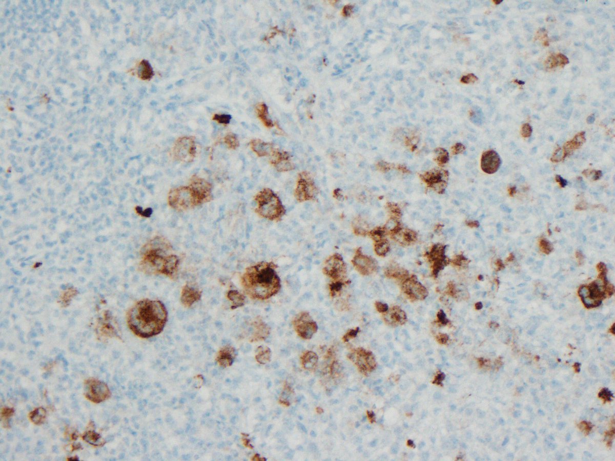 lbsmithmd's tweet photo. Beautiful CHL with pleomorphic cells. CD30, CD15 and PAX-5 shown. My wonderful mentor Dr. Bertram Schnitzer told me that CHL can have very pleomorphic cells. #mentor #hemepath #hodgkins https://t.co/Z1Qt76WRUk