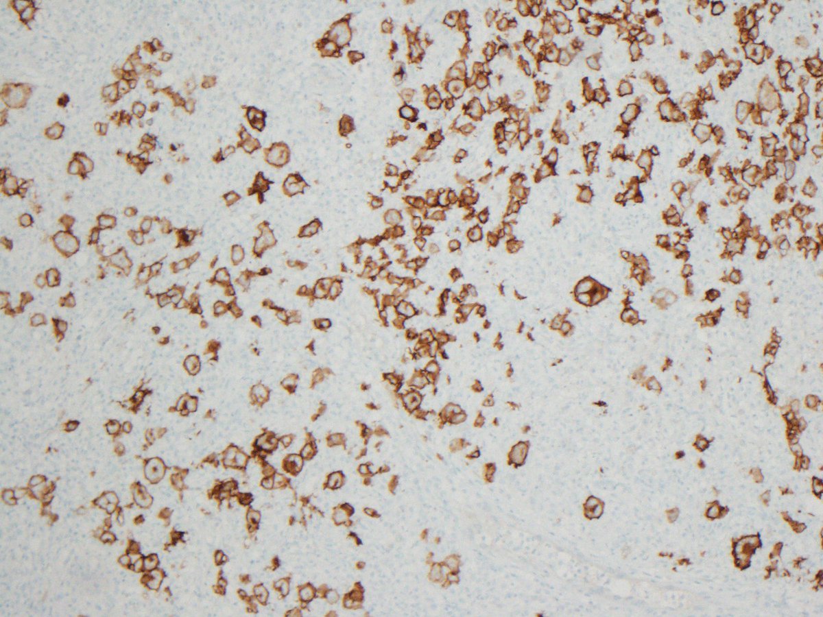 lbsmithmd's tweet photo. Beautiful CHL with pleomorphic cells. CD30, CD15 and PAX-5 shown. My wonderful mentor Dr. Bertram Schnitzer told me that CHL can have very pleomorphic cells. #mentor #hemepath #hodgkins https://t.co/Z1Qt76WRUk