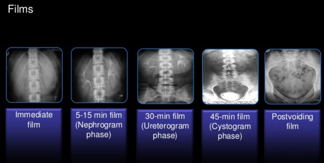 Lec 3 Contrast media : the IVU or IVP. تصوير الكلى باستخدام الصبغه 
#الاشعه
#radiology
#contrast 
#ف...