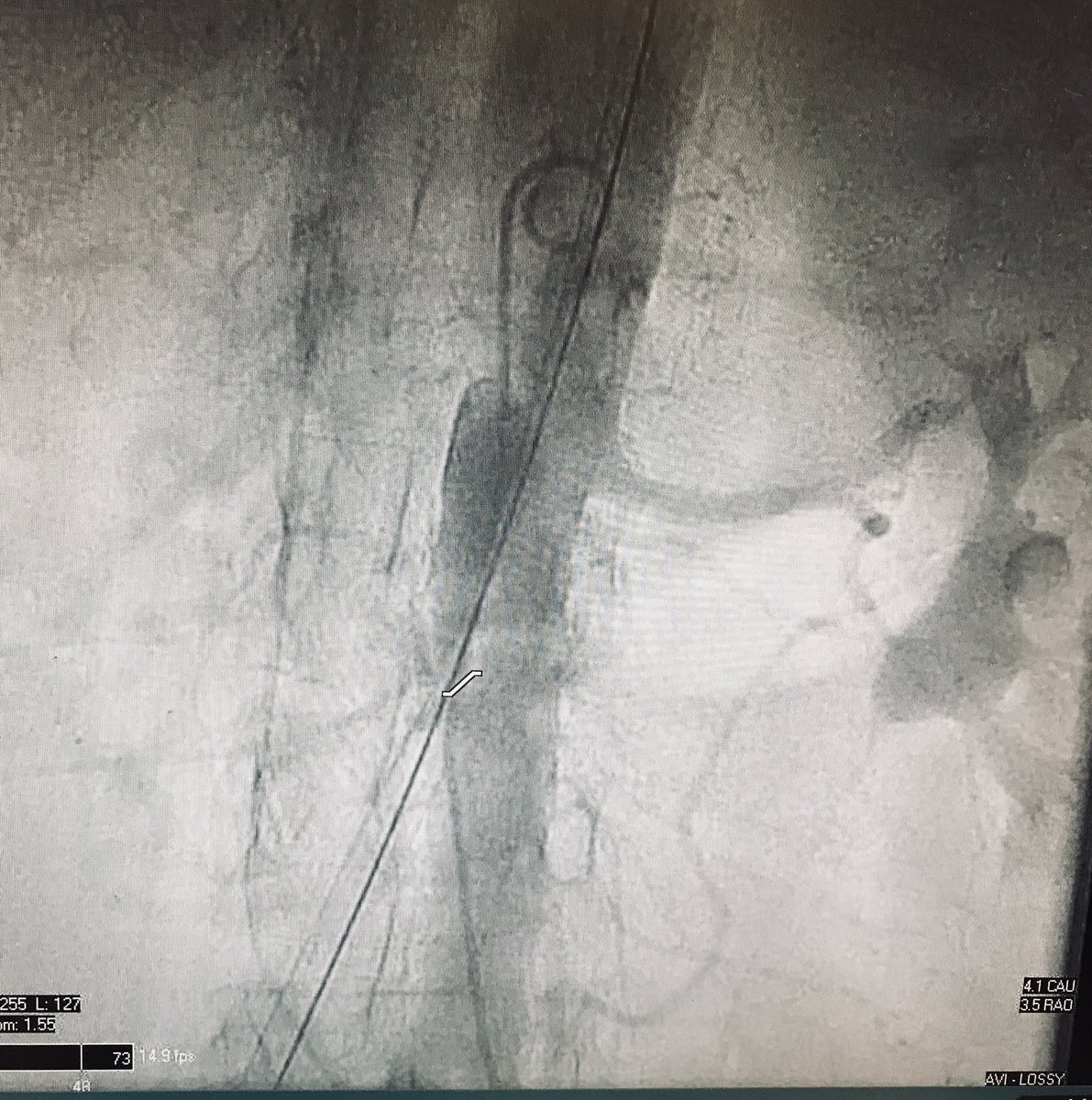 singh_phys's tweet image. First transcaval TAVR at Henrico Doctors’ Hospital!! Congratulations to the entire team and for @PaulMahoneyMD for being an awesome mentor @HenricoDoctors #TAVR #TRANSCAVAL @HCAhealthcare