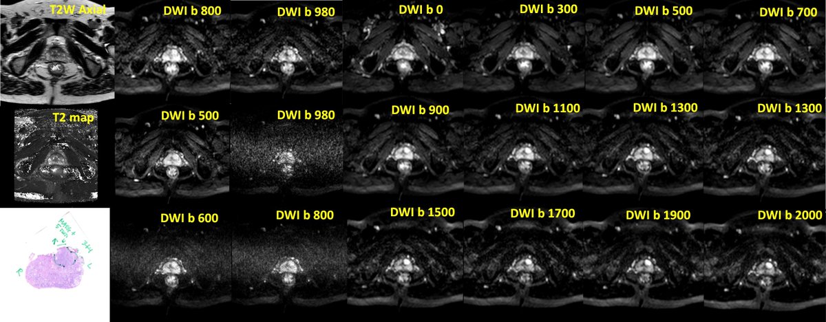 jambor_ivan's tweet photo. #prostateMRItips #tip3 #optimizeDWI #DEVILisINdetails same b-values, same patient ---> different tissue contrast depending on TE, diffusion time (DELTA-delta/3), matrix size, motion probing gradients, etc. https://t.co/LITIh2KQ9R