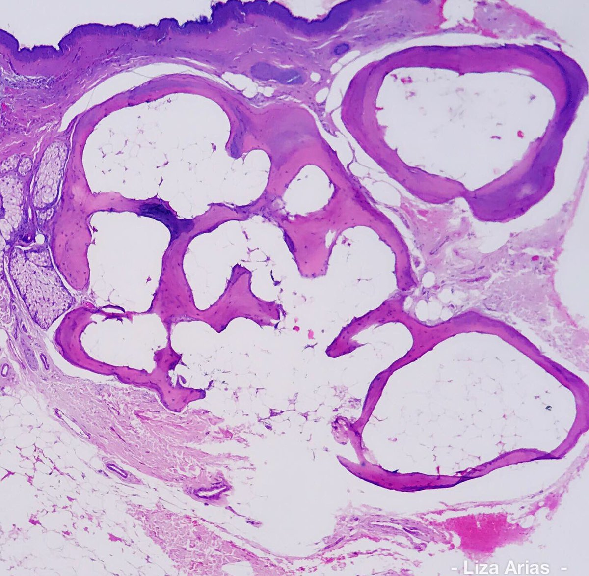 LizaAriasT's tweet photo. #OsteomaCutis
Nodules within dermis composed of lamellar bone with osteocytes in the center and osteoclasts in the external area #Dermatopathology #Dermatopathologist #PathArt #LovingDermPath #DraLizaArias https://t.co/5tVBViR9ns