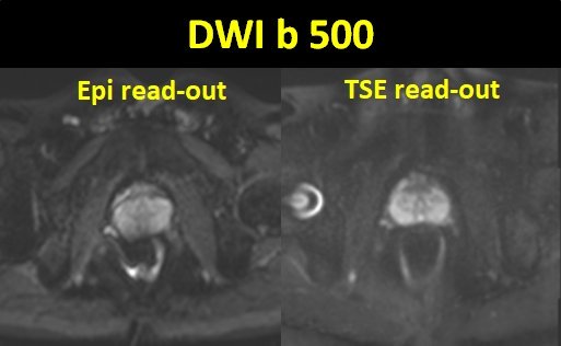 jambor_ivan's tweet photo. #prostateMRItips #tip5 #optimizeDWI optimize read-out: single shot epi will be the fastest but susceptible for B0 inhomogeneity - options: segments epi, non-epi (TSE, etc.) https://t.co/kx25duaioX