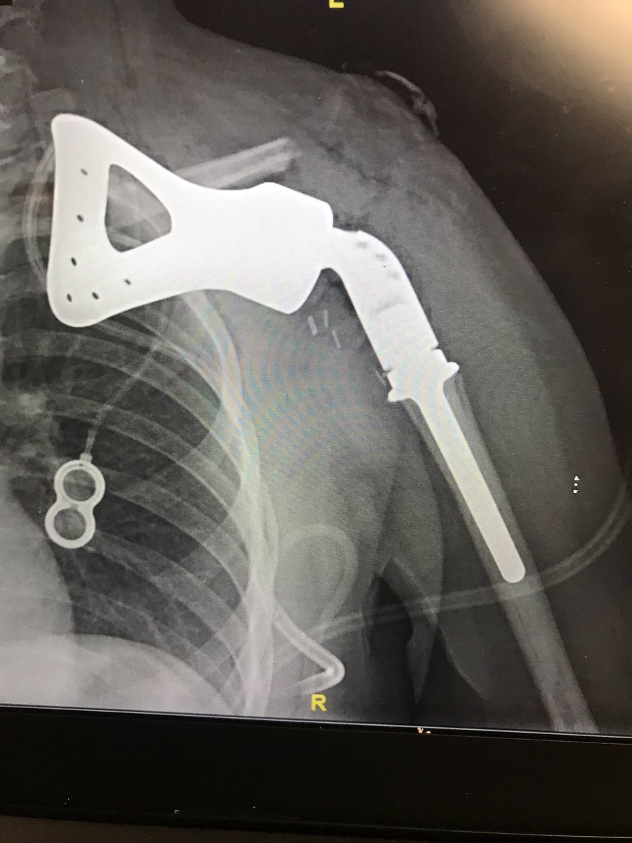 Love it when a tough limb sparing surgery comes out perfect!Teenager with #Ewingsarcoma of #scapula treated with total scapula replacement! #perfection #orthopedic #rotatorcuff #shoulderreplacement #morristownorthopedics #sarcoma #oncology #cancer