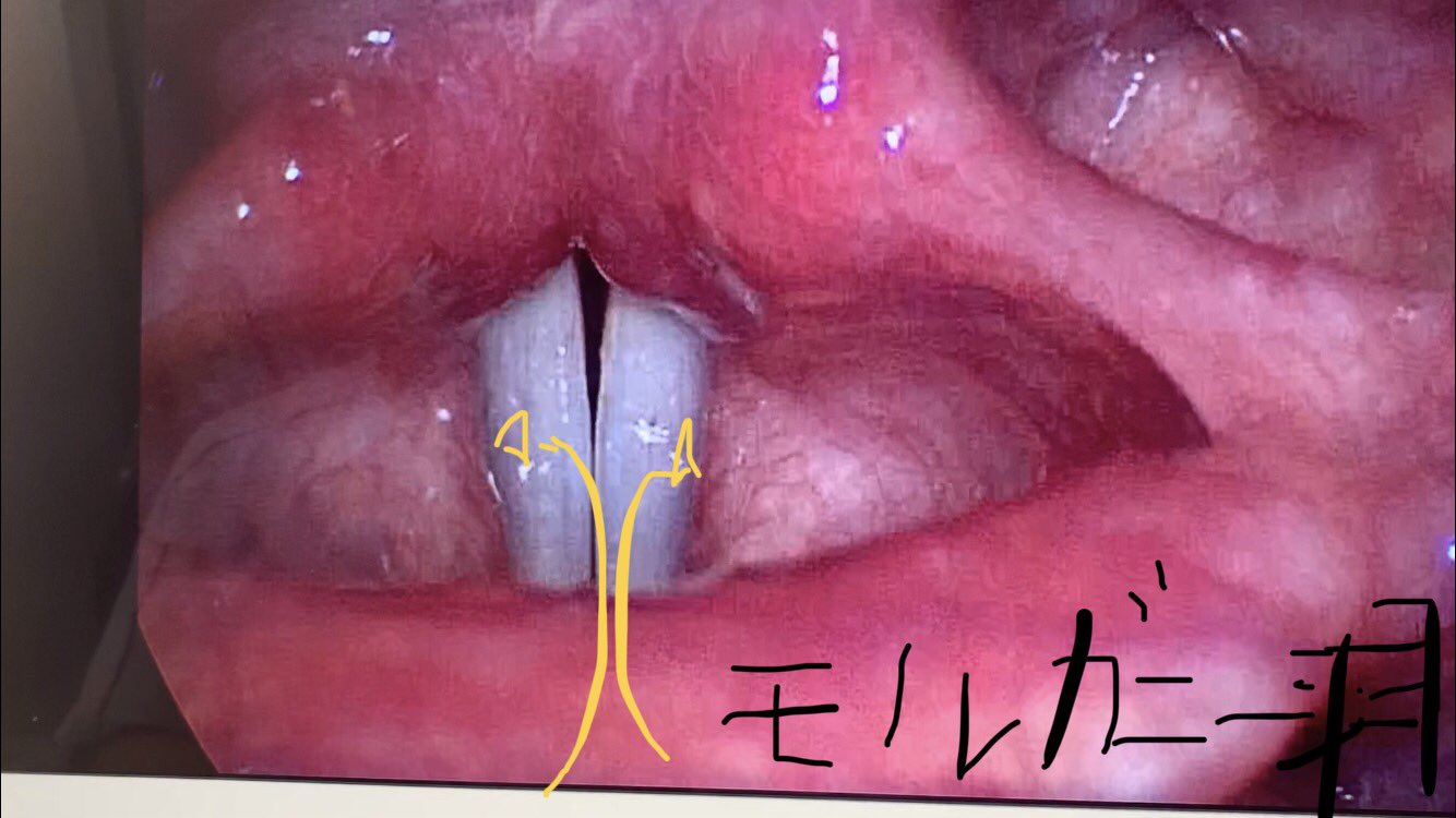 角田紘之 ガム発声が痛い イガイガするという方 声帯を上から見た写真です 声帯は上向き 仮声帯は下向き そしてその間には実は空洞 モルガニー洞というのがあります 隙間ありそうでしょ はいりたくない W ここに空洞がある 広いと思って発声して