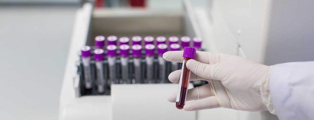 CerbaLancetTz's tweet photo. Hematology Basics: the study of blood and blood disorders. These include blood and bone marrow cells. Hematological tests can help diagnose #anemia, #infection, #hemophilia, blood-clotting disorders, and #leukemia.
#Knowyourlab #knowyourtests https://t.co/ACb18h3RZX
