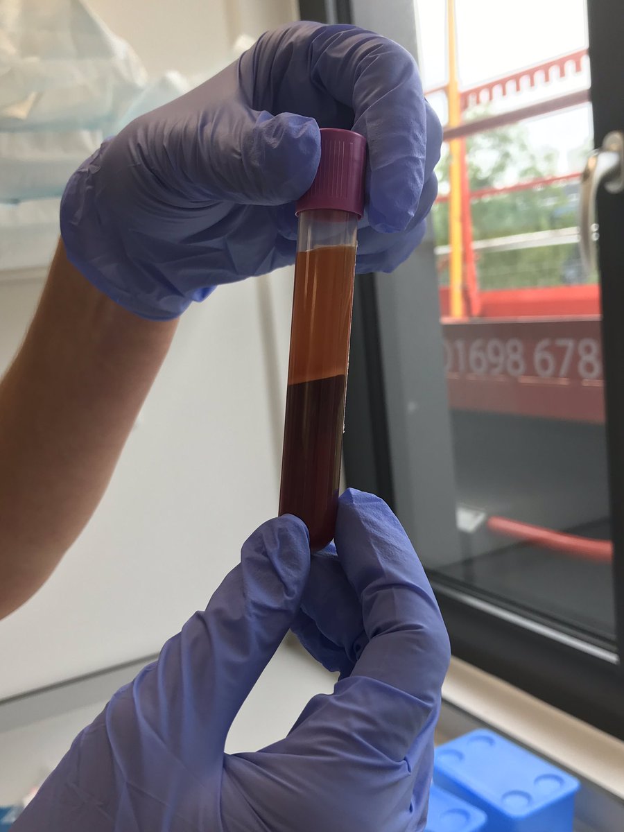EdinburghCRF's tweet image. #LabSkills workshop pilot today @EdinburghCRF #SampleProcessing with #fakeblood proved rather successful #smugface