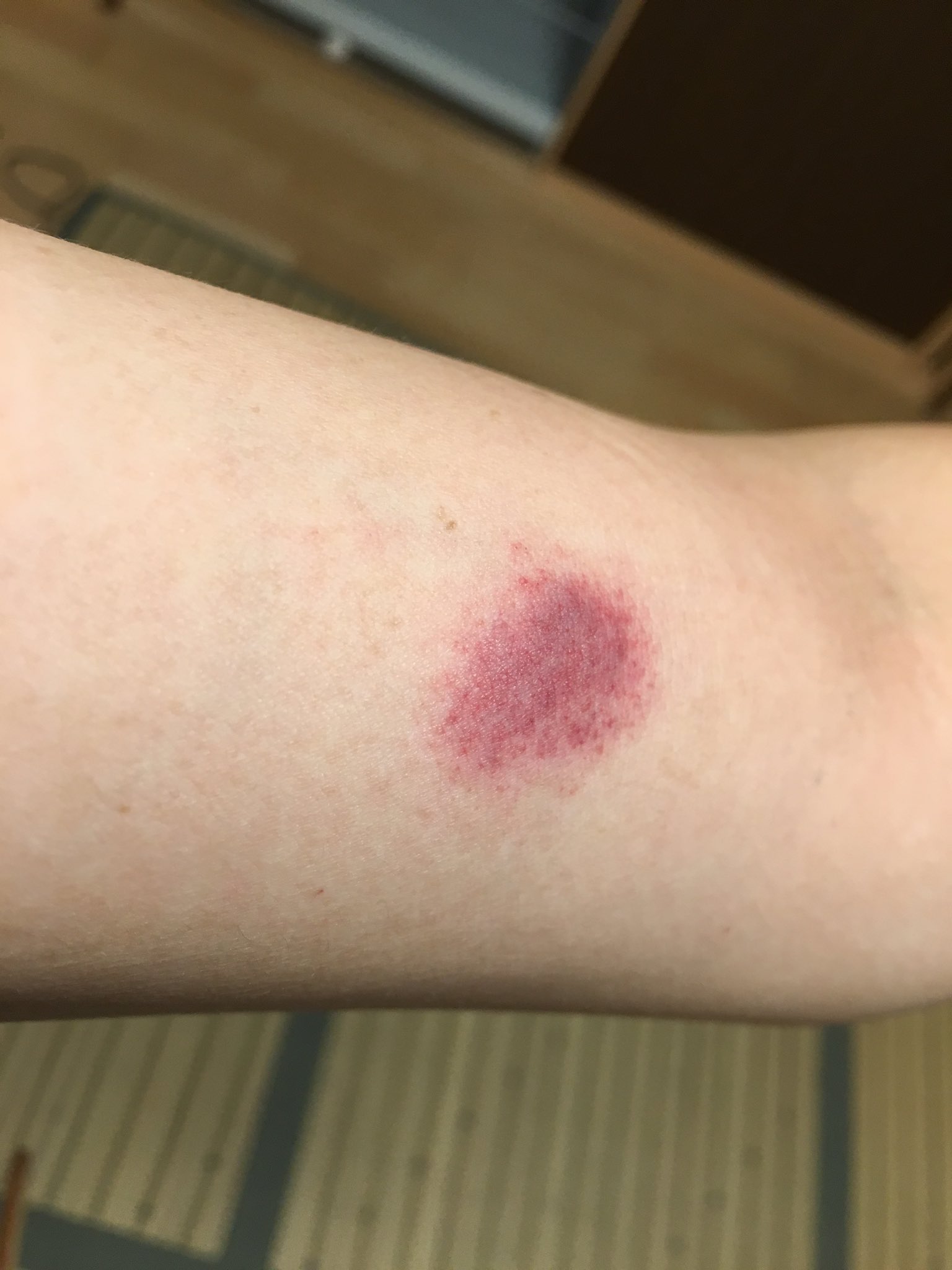 そらっち 二の腕にキスマーク チビたんに吸われたー 7か月 赤ちゃんキスマーク