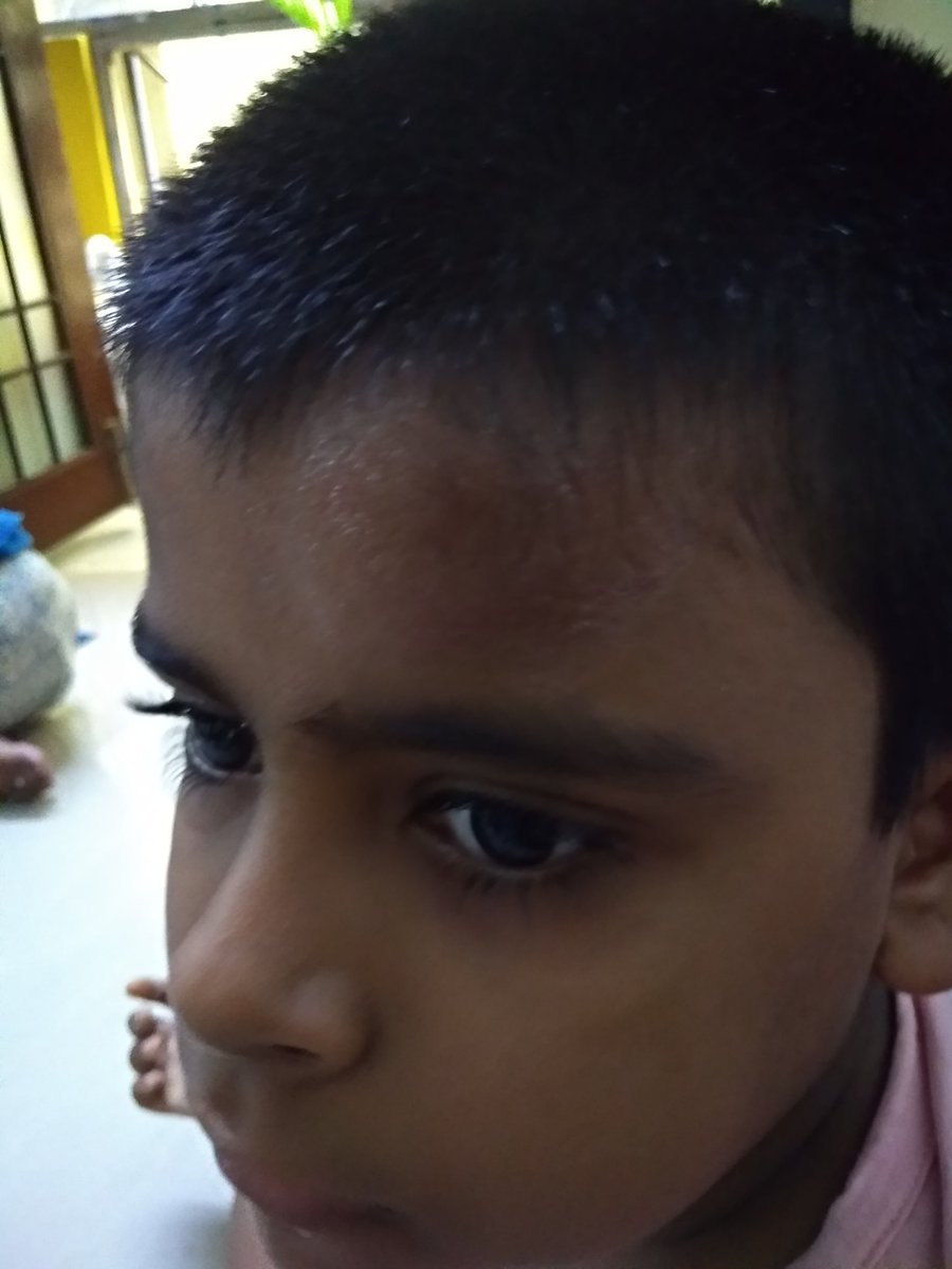 francispratap's tweet photo. Hi Velammal Team... My son is studying in Velammal NewGen in Thiruvottiyur. As class teacher (3rd STD 3C) couldn't control their students my son and other boy banged their head and fore head swollen .#velammal#Chairman. Kindly reach me on +919080324572. Dear Velammal hospital - https://t.co/3HUWHZ7lW8