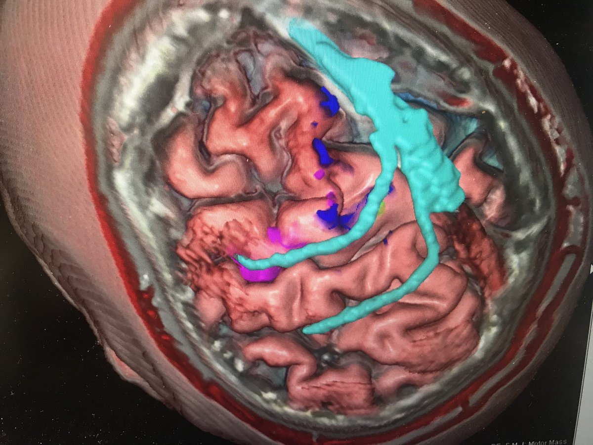 ShermanMDneuro's tweet photo. Virtual reality #VR for patient engagement and surgical planning for treatment of a brain tumor. #innovation #VR #surgicaltheater #neurosurgery #definingmedicine @GWSMHS @GW_MFA @GWHospital @virtrealitytime @RealityVirtuaI https://t.co/06IBcQXVaY