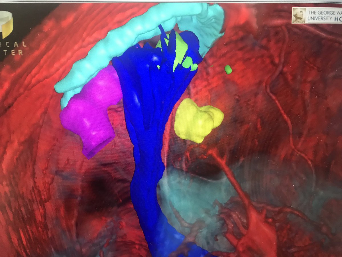 ShermanMDneuro's tweet photo. Virtual reality #VR for patient engagement and surgical planning for treatment of a brain tumor. #innovation #VR #surgicaltheater #neurosurgery #definingmedicine @GWSMHS @GW_MFA @GWHospital @virtrealitytime @RealityVirtuaI https://t.co/06IBcQXVaY