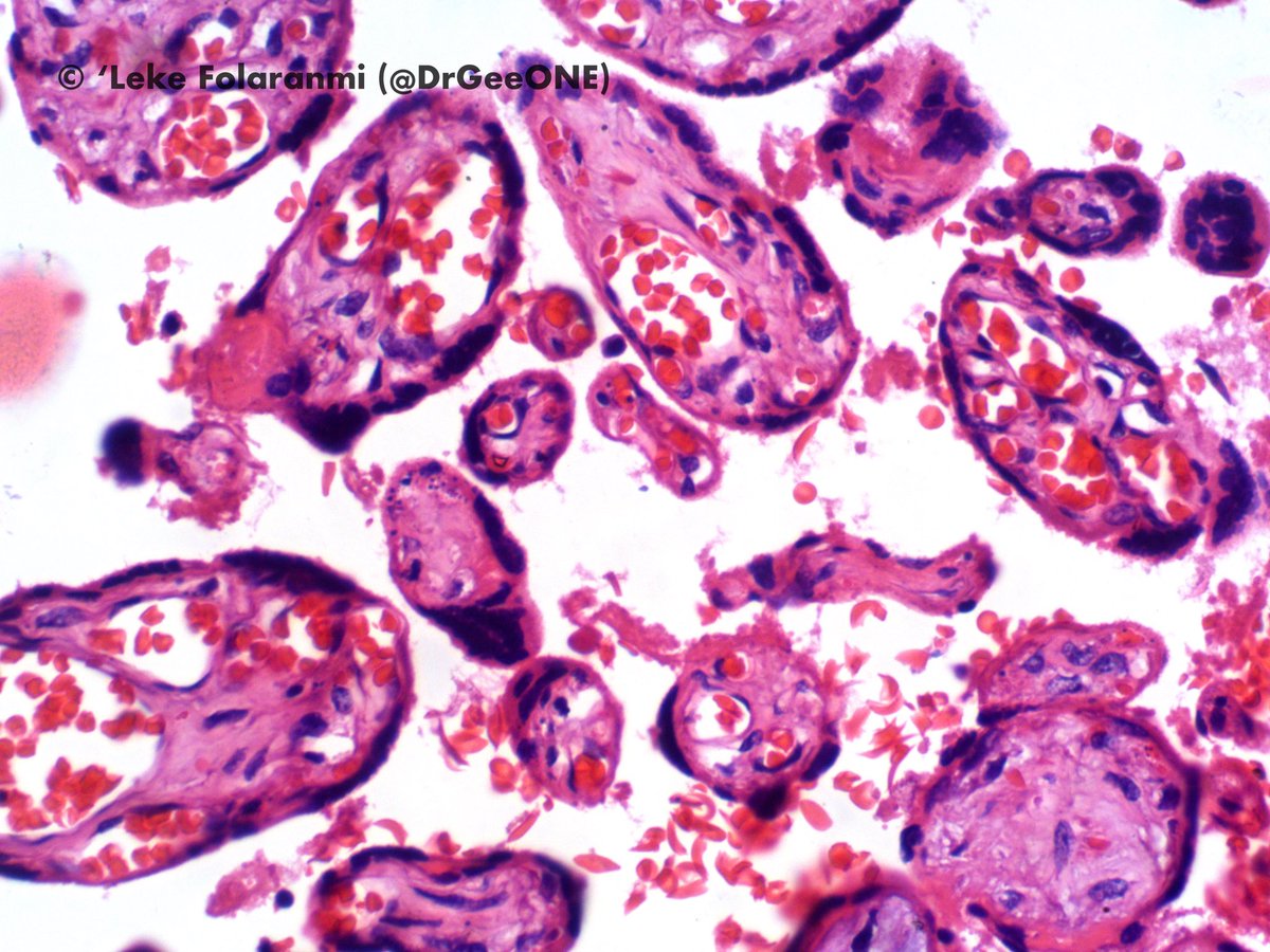 DrGeeONE's tweet photo. Sickled Red Cells in the Intervillous lakes.
Placental changes in Sickle Cell Disease
@menorka @D4L14H @RunjanChetty @UMichPath @SUNYUpstatePath 
#Gynpath #Hemepath https://t.co/CTWq8SXidc