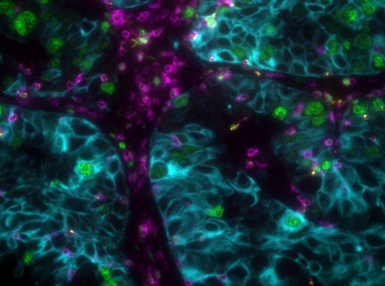 Check out this 40x image of this NSCLC tissue stained with our UltiMapper I/O T-act Kit and scanned with @RareCyte's CyteFinder II. hubs.ly/H0kgD1r0 #tissueimaging #multiplexing #immunooncology #biomarkers #ki67 #tumormicroenvironment