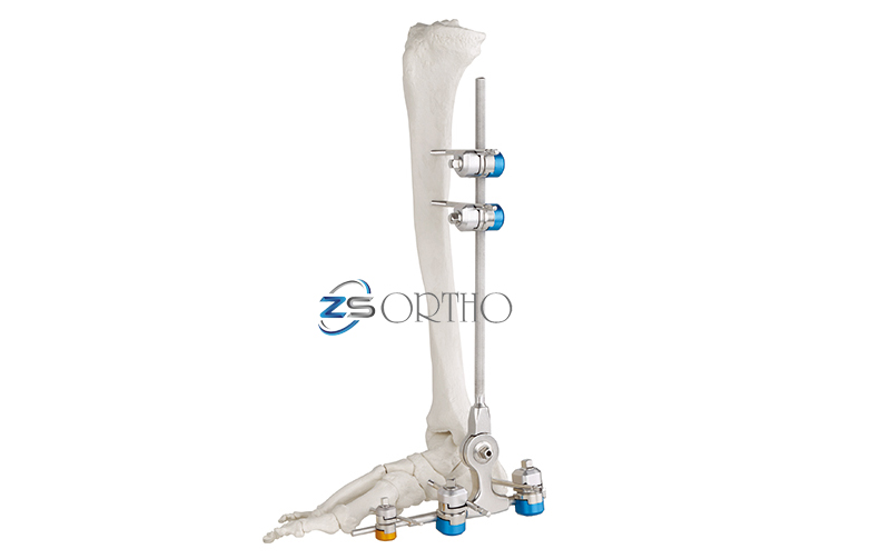 ZSORTHOSOLUTION's tweet photo. Stryker Hoffmann type external fixator
https://t.co/0vAv78fehO
#externalfixator #orthopaedicsurgeons #orthopedicsurgery #medicaldevices #fracture #externalfixator #saturnortho #bonefixator #bonefixation #ortho #orthopaedic #orthopedic https://t.co/97VofT2D0Z