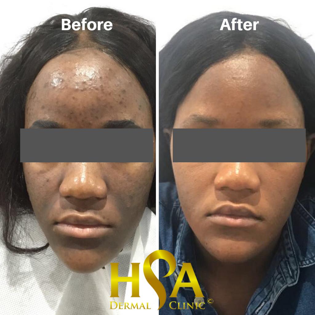skrive behandle niveau HSA Dermal Clinic on X: "Do you suffer from Acne, Hyperpigmentation,  Melasma or uneven skin tone? Check this before and after photo for our  client that needed treatment for Acne, hyperpigmentation, melasma