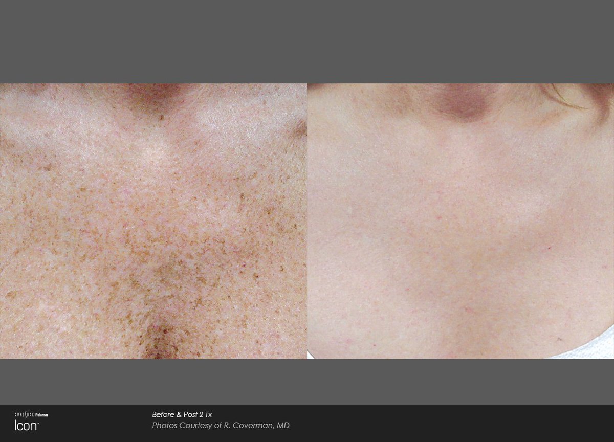 AssuageCenters1's tweet image. Our Intense Pulse Light ( #IPL ) Photo Facial can fight Acne⚡Sun Damage⚡Rosacea⚡Age spots⚡Facial redness⚡Freckles⚡Pore size
So if you&apos;d like softer, supple, more even looking skin, we&apos;ll give you $50 off one or $100 off a series of 3, but only during August #SpaTechnology