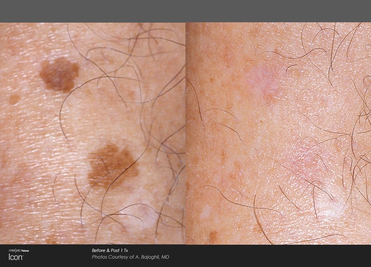 AssuageCenters1's tweet image. Our Intense Pulse Light ( #IPL ) Photo Facial can fight Acne⚡Sun Damage⚡Rosacea⚡Age spots⚡Facial redness⚡Freckles⚡Pore size
So if you&apos;d like softer, supple, more even looking skin, we&apos;ll give you $50 off one or $100 off a series of 3, but only during August #SpaTechnology