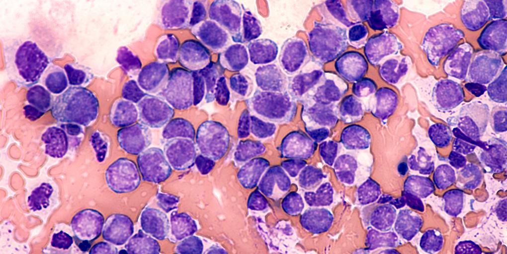 CD_AACR's tweet photo. #ResearchWatch: Splicing factor-mutant #leukemia is sensitive to #PRMT inhibition.
@sloan_kettering @IcahnMountSinai
https://t.co/zo9RuTFajw https://t.co/mIglK5CnKh