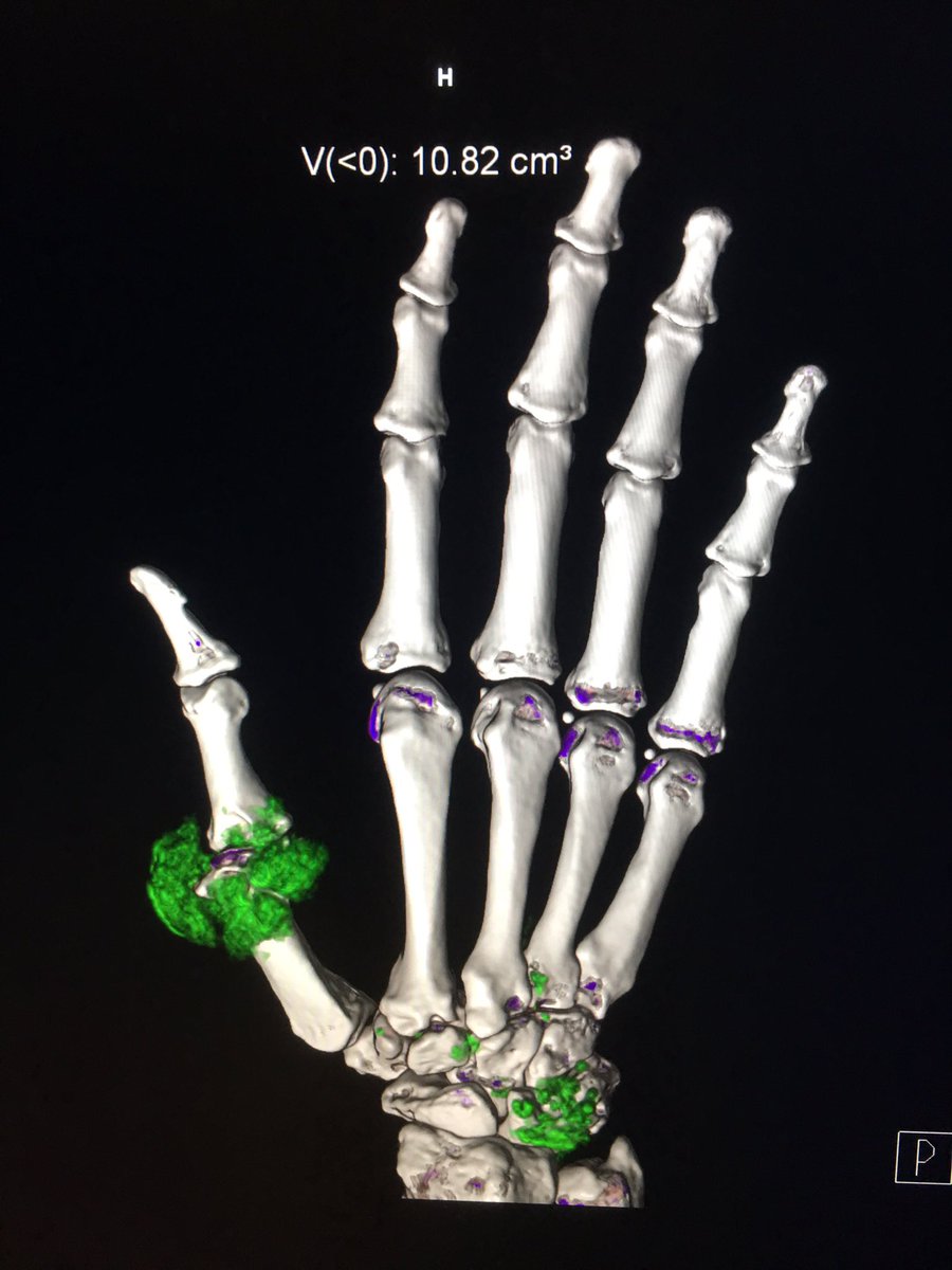 ShamimUmarji's tweet photo. Super Hand MDT 2day - dual energy CT for diagnosis of gout . Brill service from radiologists @StGeorgesTrust #radiology #NHS #nevertooldtolearn s https://t.co/nG3bZ7A1bg