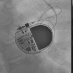 steffenmeBCHS's tweet photo. Happy 5th Anniversary to Buddy, the little fella who still gets my heart going all these years later. Still beating, still grateful. ❤️🔋 #aliveday #wired #pacemakerlife https://t.co/uE06YJWMsH