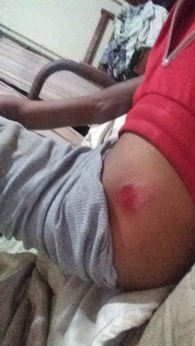 1 pic. Hey everyone i had a pretty nasty fall off of my skateboard today that banged me up pretty bad