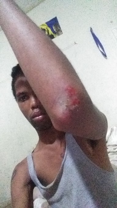 2 pic. Hey everyone i had a pretty nasty fall off of my skateboard today that banged me up pretty bad