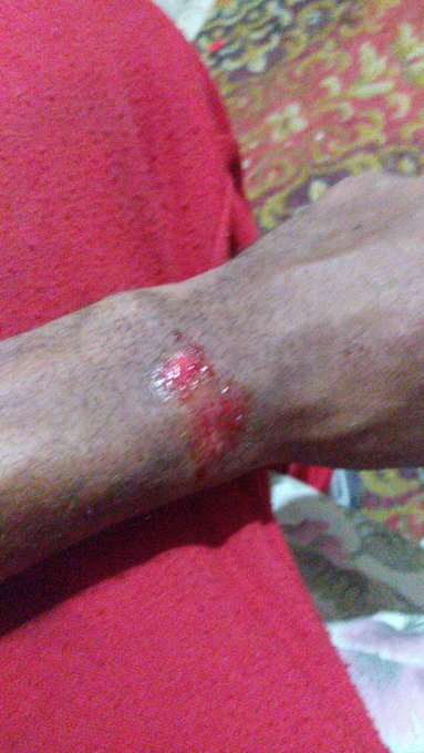 3 pic. Hey everyone i had a pretty nasty fall off of my skateboard today that banged me up pretty bad