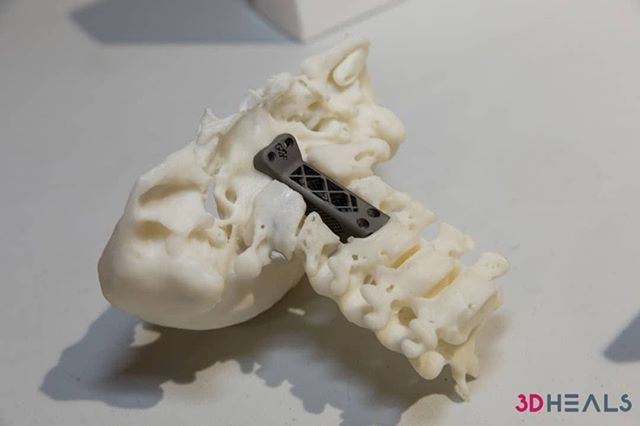 3dheals's tweet image. Road to reimbursements for 3d printed anatomical models and surgical guides – Decoding the CPT codes @3dheals @AmerMedicalAssn @RadiologyACR #3dprinting #CPTCode #Reimbursement #RSNASIG #Medical3dprinting #AnatomicalModels #technology #JointheTribe … ift.tt/2ZtofNW