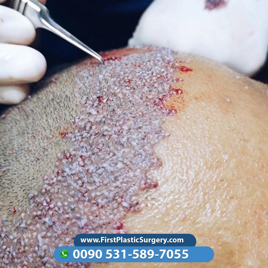 CosmeticsTurkey's tweet image. Well done is better than well said.👌😎
First Plastic Surgery Clinic - Istanbul 📱☎️00905315897055 
#plasticsurgery #bingowings #facelift #plasticsurgeon #beauty #cosmeticsurgery #bodycontouring #aestheticsurgery #cosmeticsurgeon #mastopexy #breastimplant #aestheticsurgeon #UAE