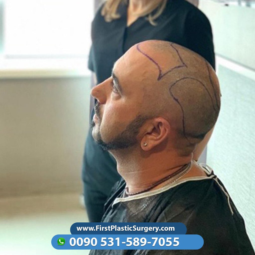 CosmeticsTurkey's tweet image. the  best hair transplant in turkey guide medical 
WhatsApp 🇬🇧🇫🇷00905066633722
🇪🇸🇮🇹00905066633722
#love #instagood #me #tbt #cute #follow #followme #photooftheday #happy
#tagforlikes #beautiful #self #like4like #smile #friends #fun #like #fashion
#instadaily #instalike #summer